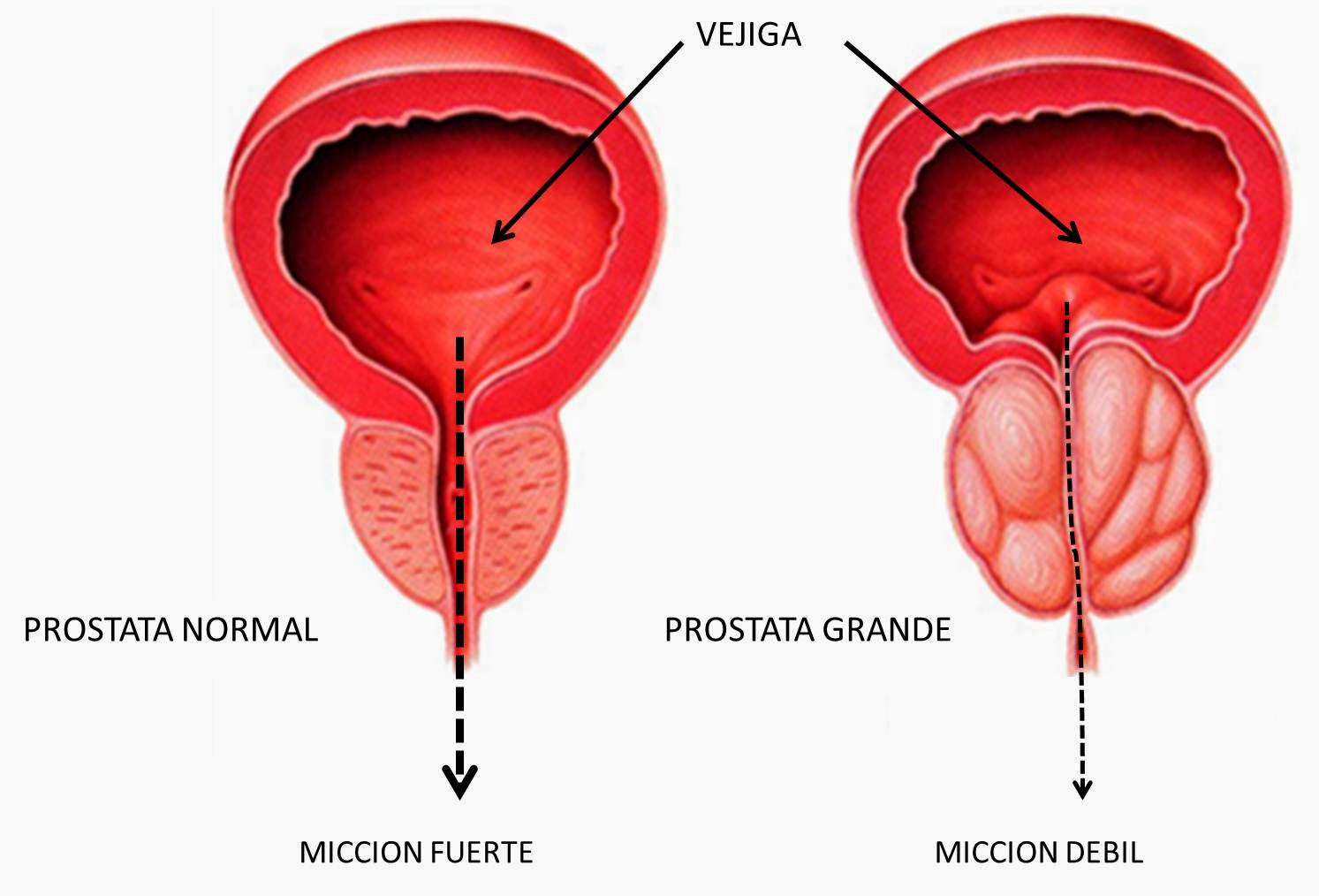 tratamiento de prostatitis aguda e infertilidad